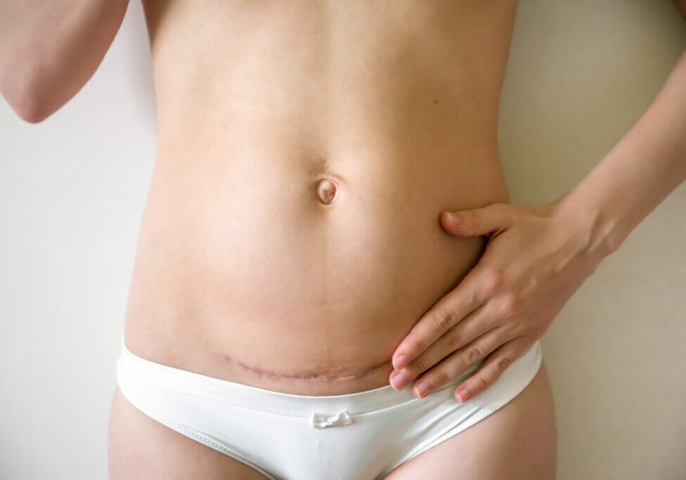 Cesarean Scar